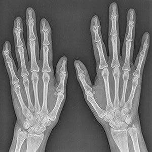 Baja Hand - Hand and Finger treatment